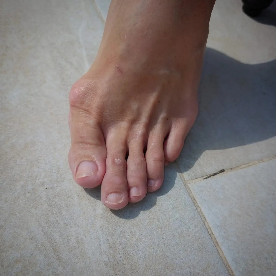 Bunion Bliss