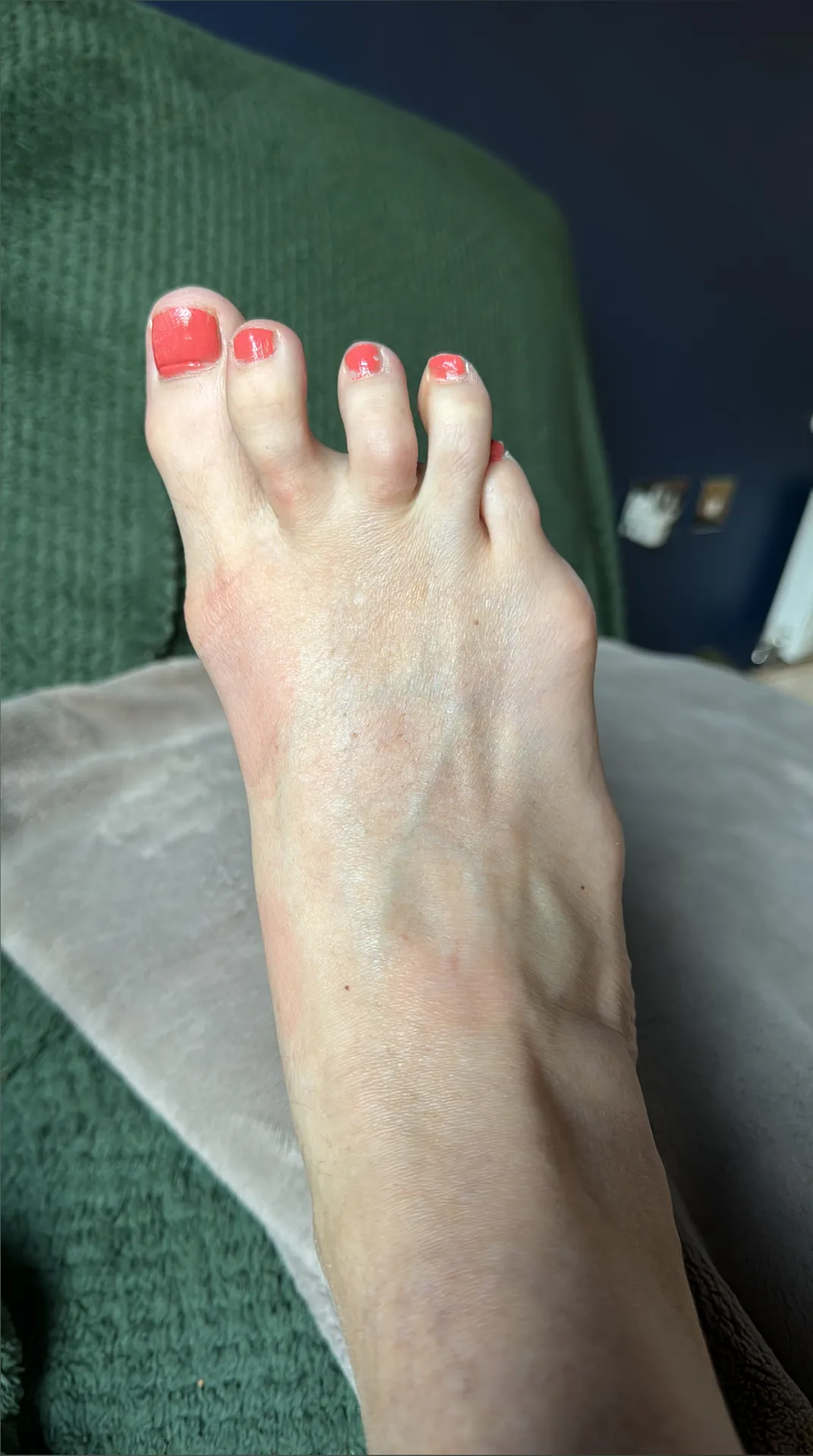 Bunions Heels and Toes