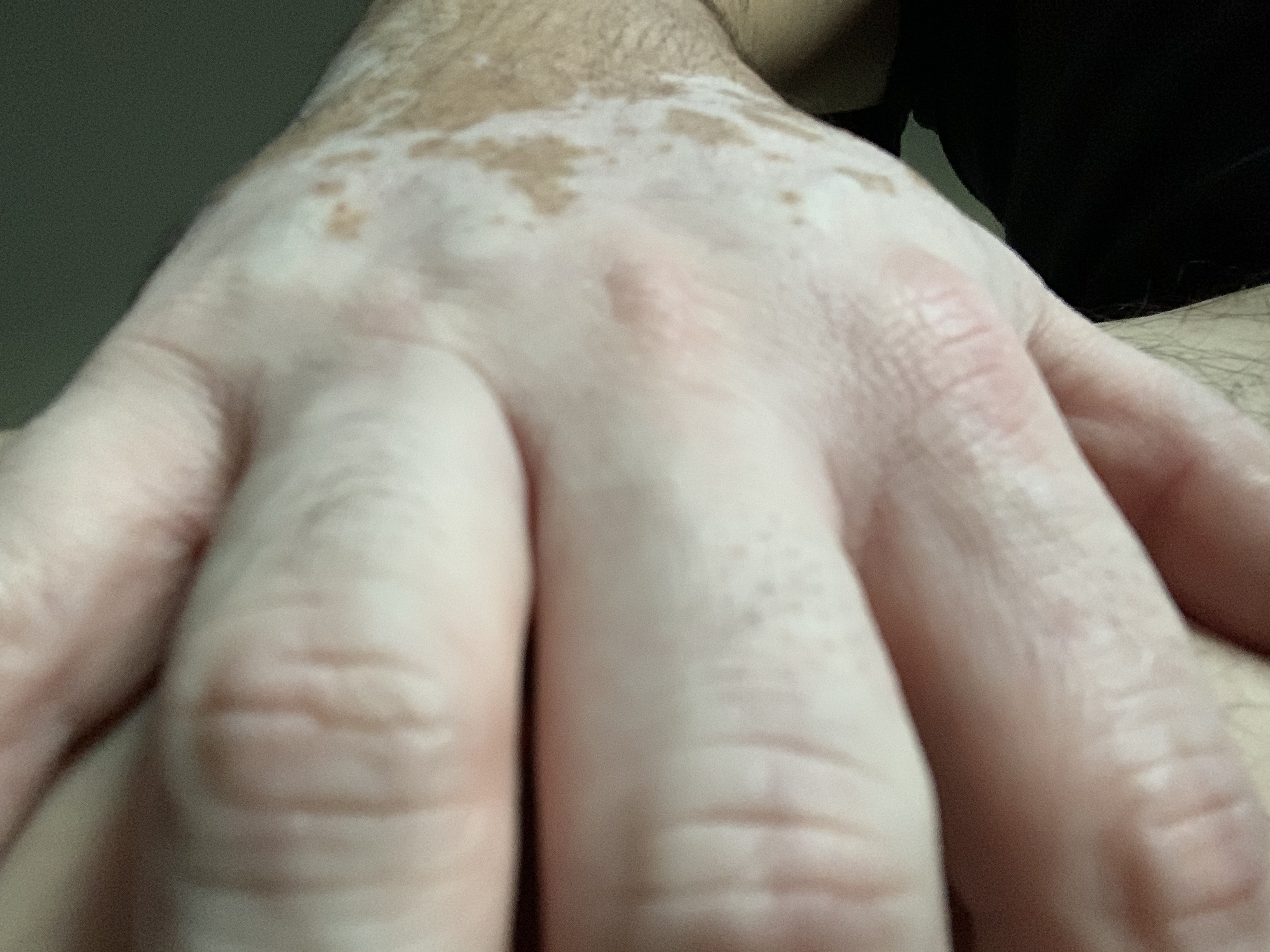 Vitiligo Body Exposed OnlyFans header